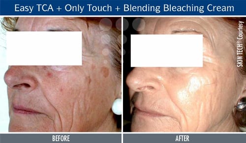 Peeling Peeling